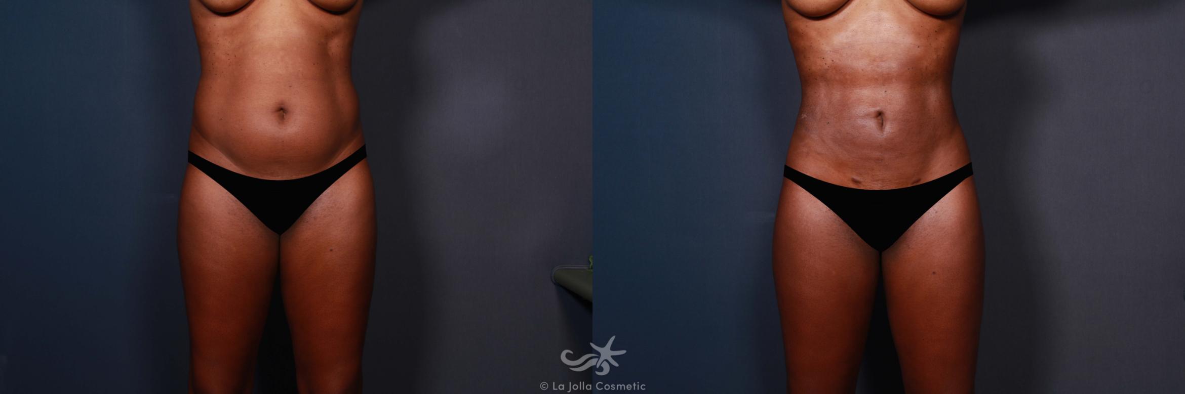 Before & After High Definition Liposuction Result 577 Front View in San Diego, CA