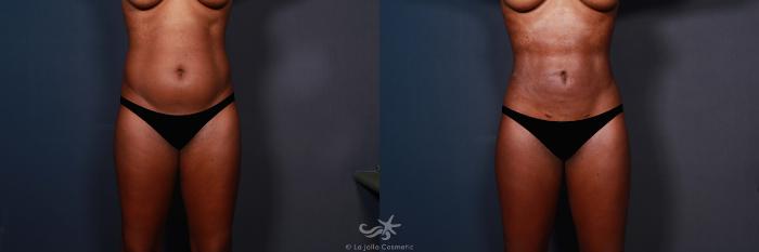 Before & After High Definition Liposuction Result 577 Front View in San Diego, Carlsbad, CA