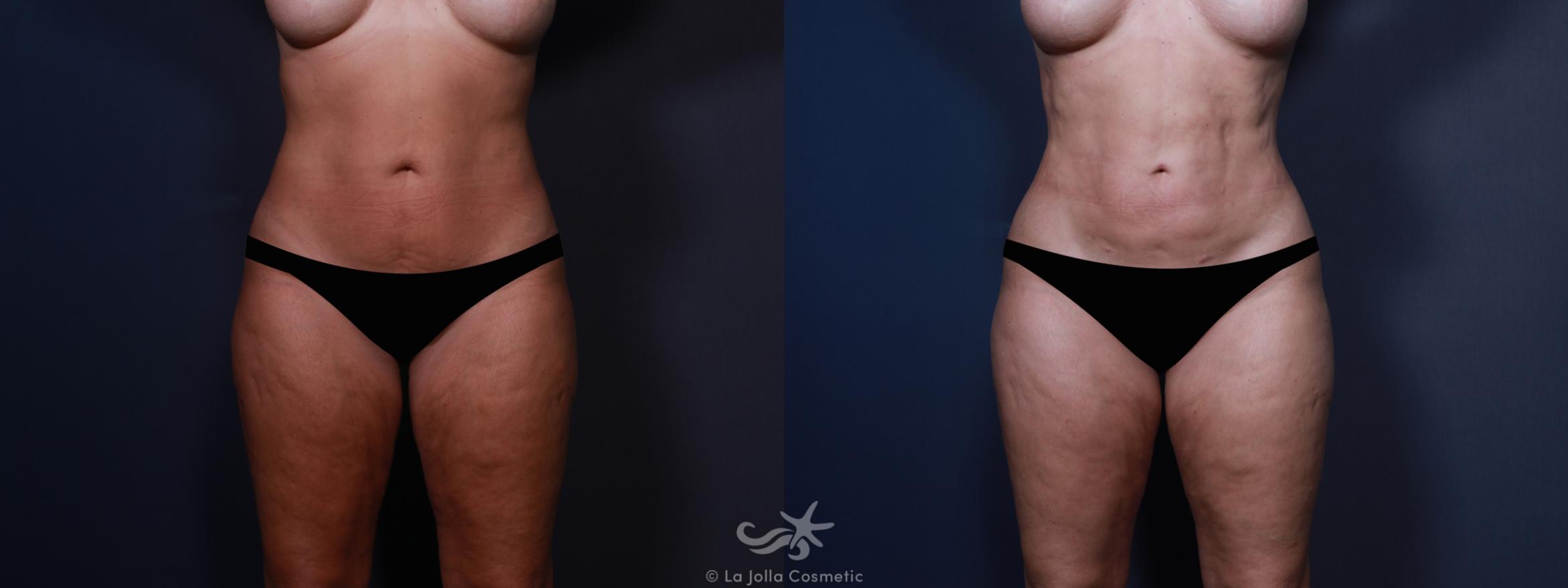 Before & After High Definition Liposuction Result 603 Front View in San Diego, CA