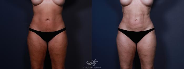 Before & After High Definition Liposuction Result 603 Front View in San Diego, Carlsbad, CA