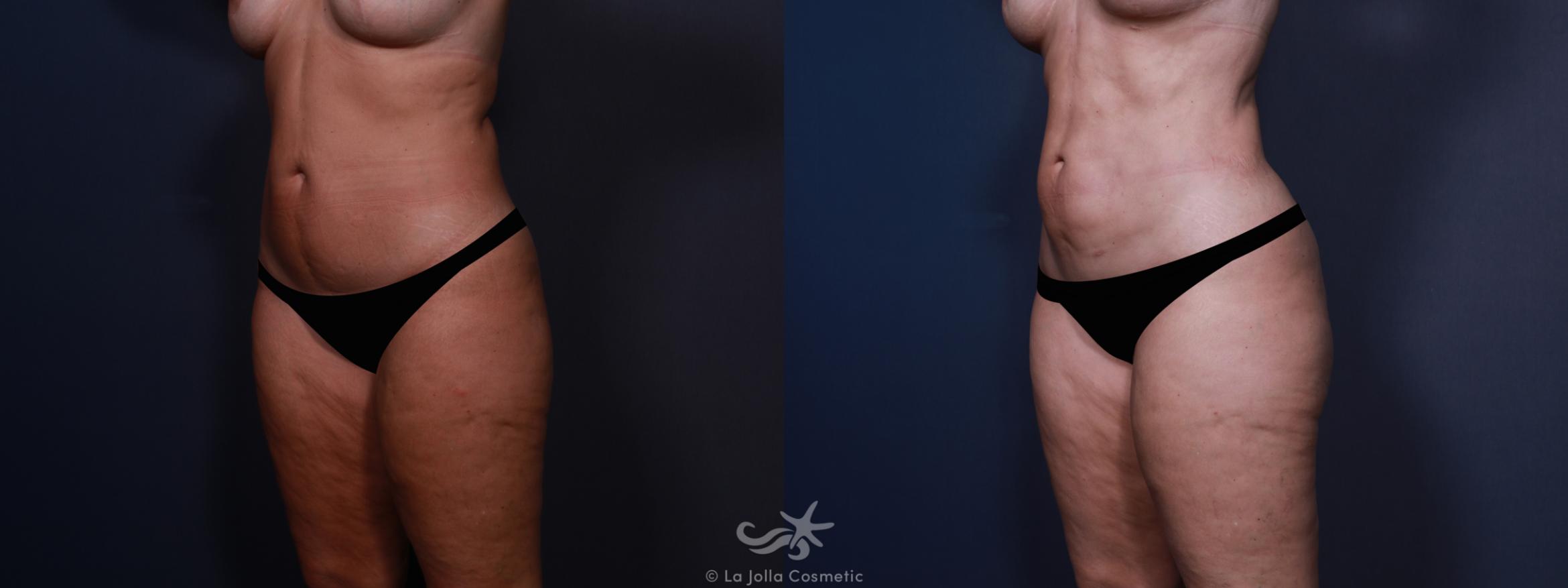Before & After High Definition Liposuction Result 603 Left Oblique View in San Diego, CA