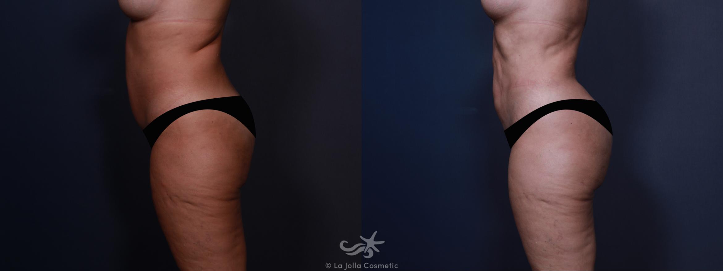 Before & After High Definition Liposuction Result 603 Left Side View in San Diego, CA