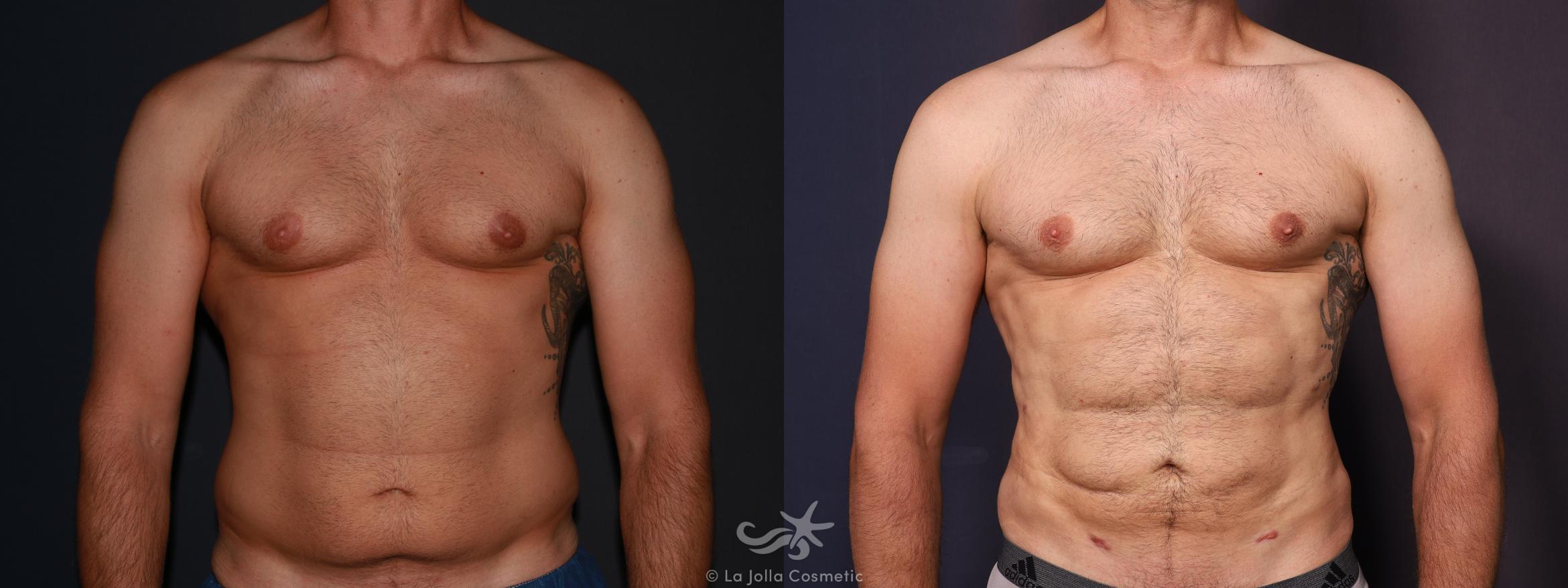 Before & After High Definition Liposuction Result 647 Front View in San Diego, CA