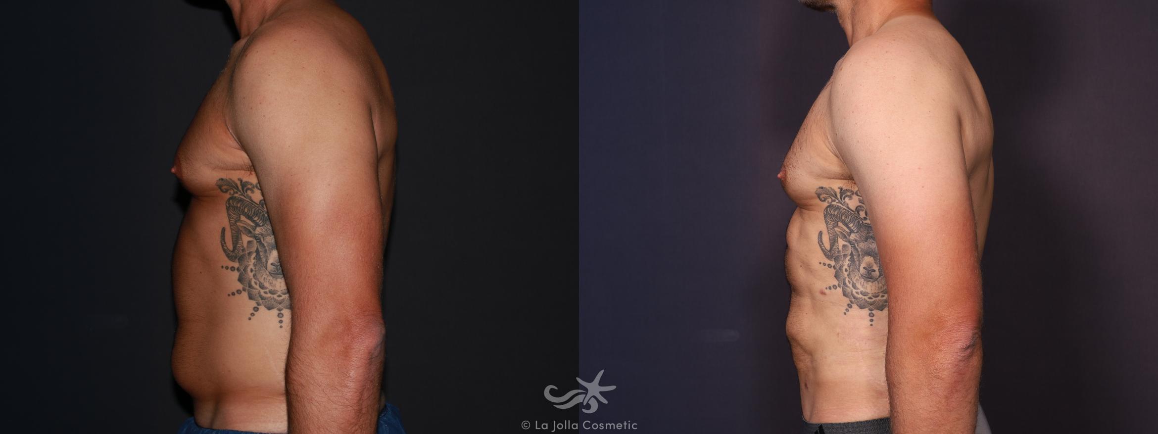 Before & After High Definition Liposuction Result 647 Left Side View in San Diego, CA