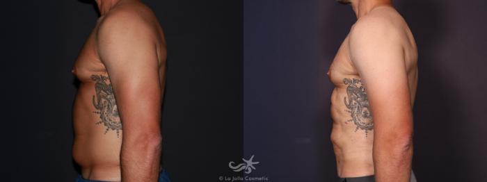 Before & After High Definition Liposuction Result 647 Left Side View in San Diego, Carlsbad, CA