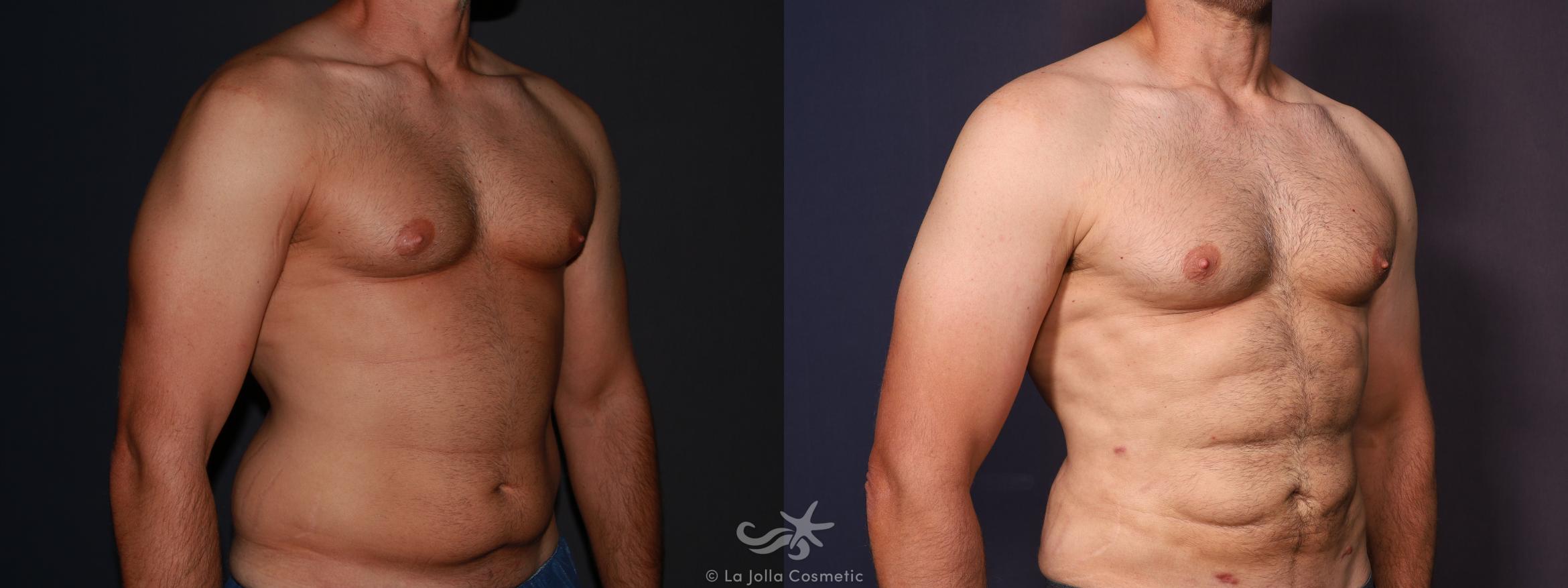 Before & After High Definition Liposuction Result 647 Right Oblique View in San Diego, CA
