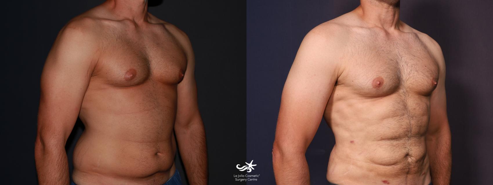 Before & After High Definition Liposuction Result 647 Right Oblique View in San Diego, CA