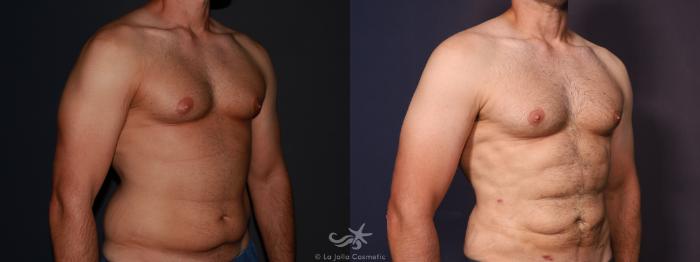 Before & After High Definition Liposuction Result 647 Right Oblique View in San Diego, Carlsbad, CA
