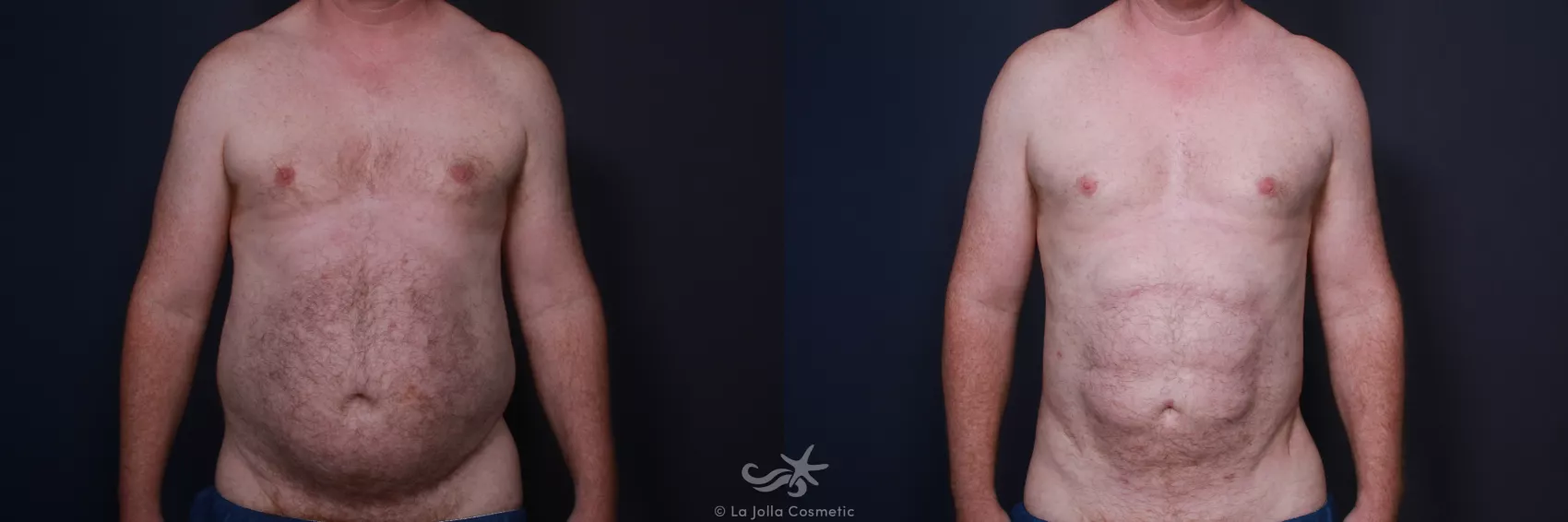 Before & After High Definition Liposuction Result 66 Front View in San Diego, CA