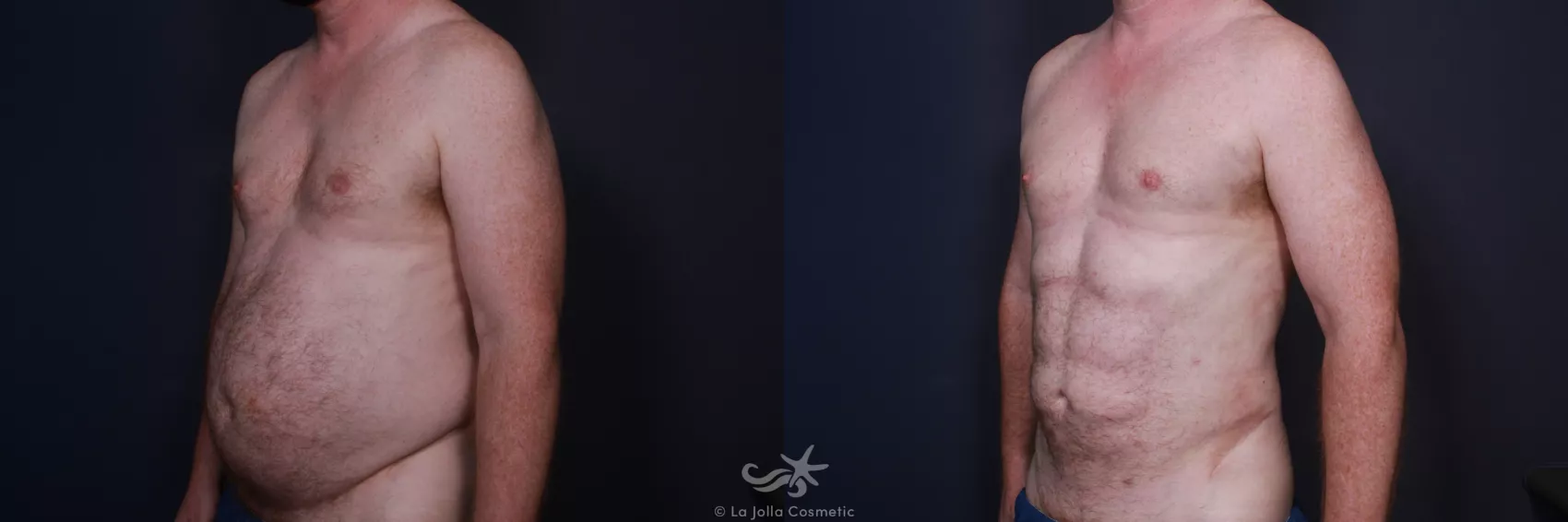 Before & After High Definition Liposuction Result 66 Left Oblique View in San Diego, CA