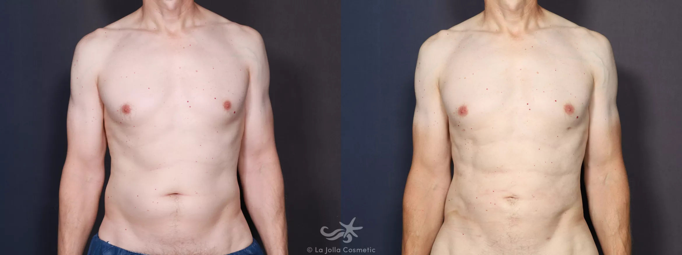 Before & After High Definition Liposuction Result 733 Front View in San Diego, CA