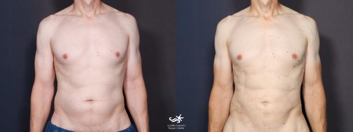 High Definition Liposuction Before and After Photo Gallery, San Diego, CA