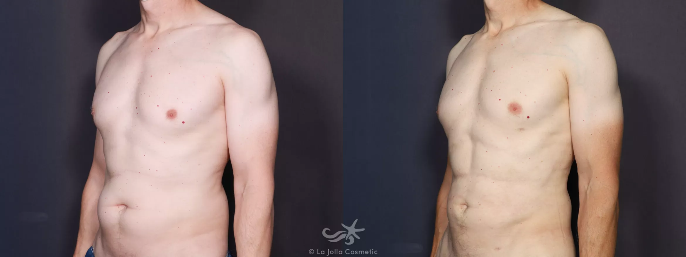 Before & After High Definition Liposuction Result 733 Left Oblique View in San Diego, CA