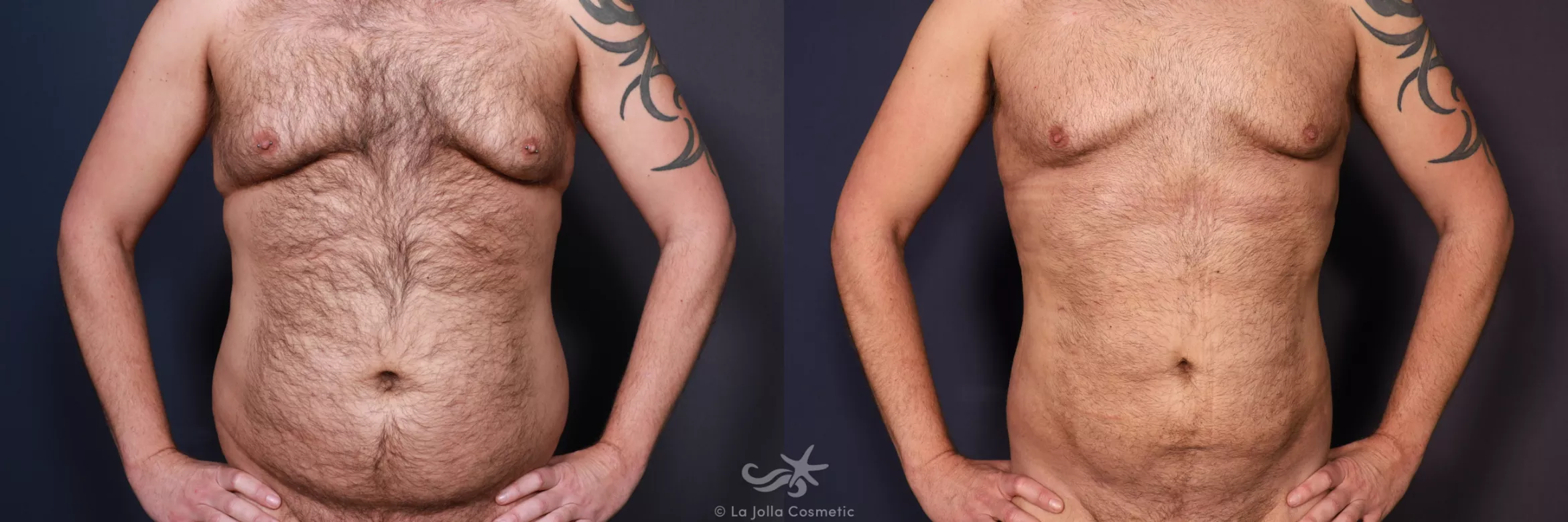 Before & After High Definition Liposuction Result 740 Front  View in San Diego, CA