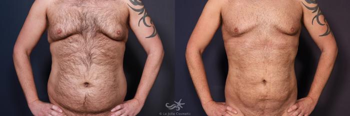 Before & After High Definition Liposuction Result 740 Front  View in San Diego, Carlsbad, CA