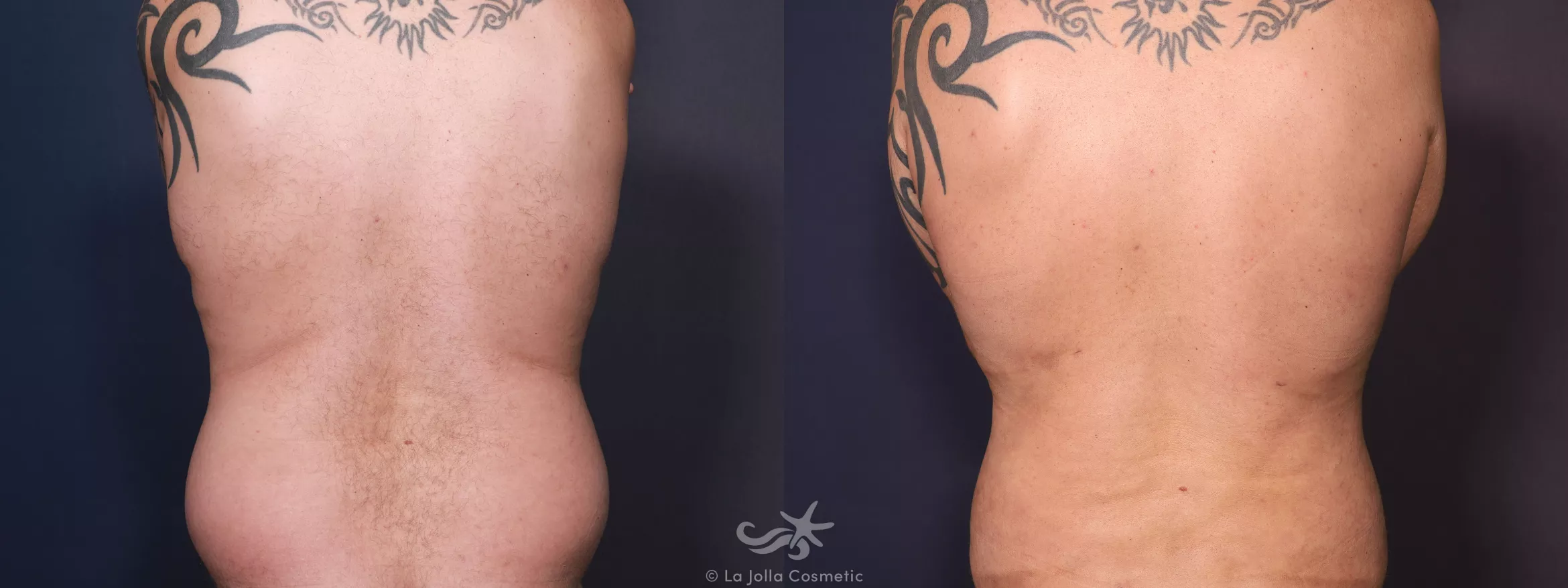 Before & After High Definition Liposuction Result 740 Left Oblique View in San Diego, CA