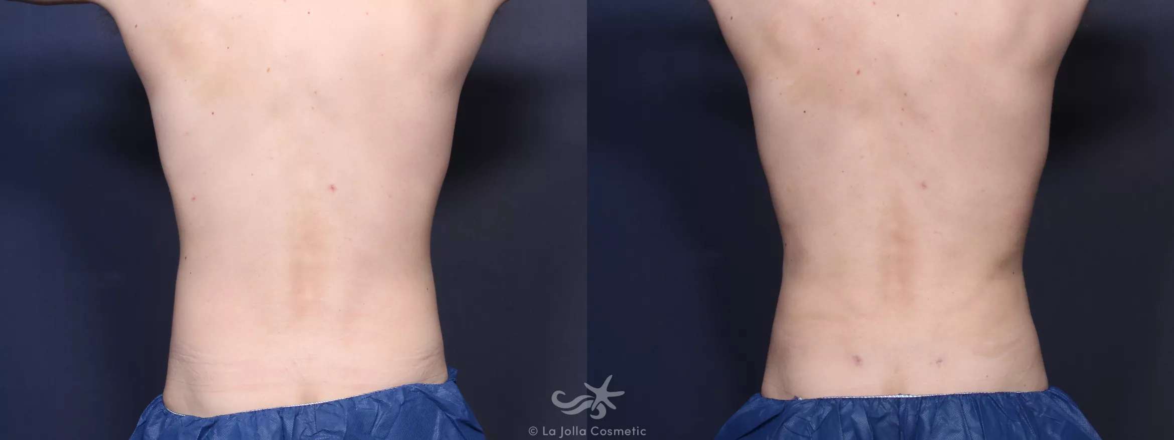 Before & After High Definition Liposuction Result 90 Back View in San Diego, CA