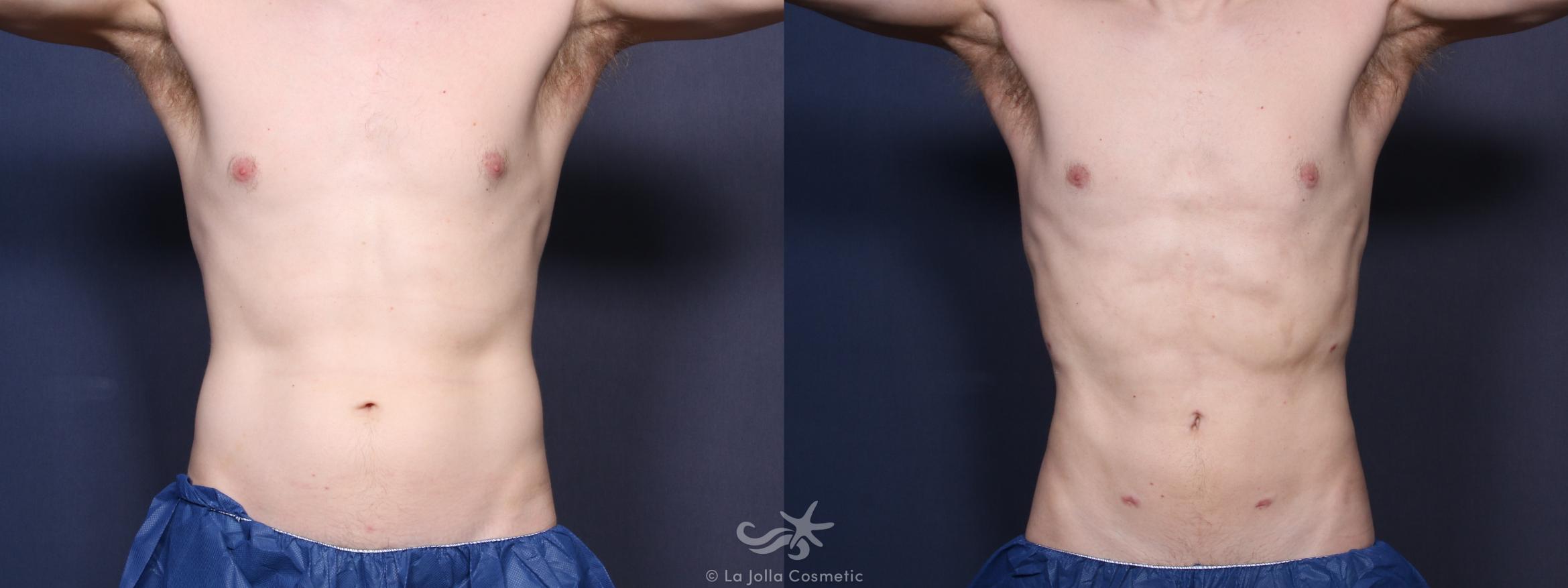 Before & After High Definition Liposuction Result 90 Front View in San Diego, CA