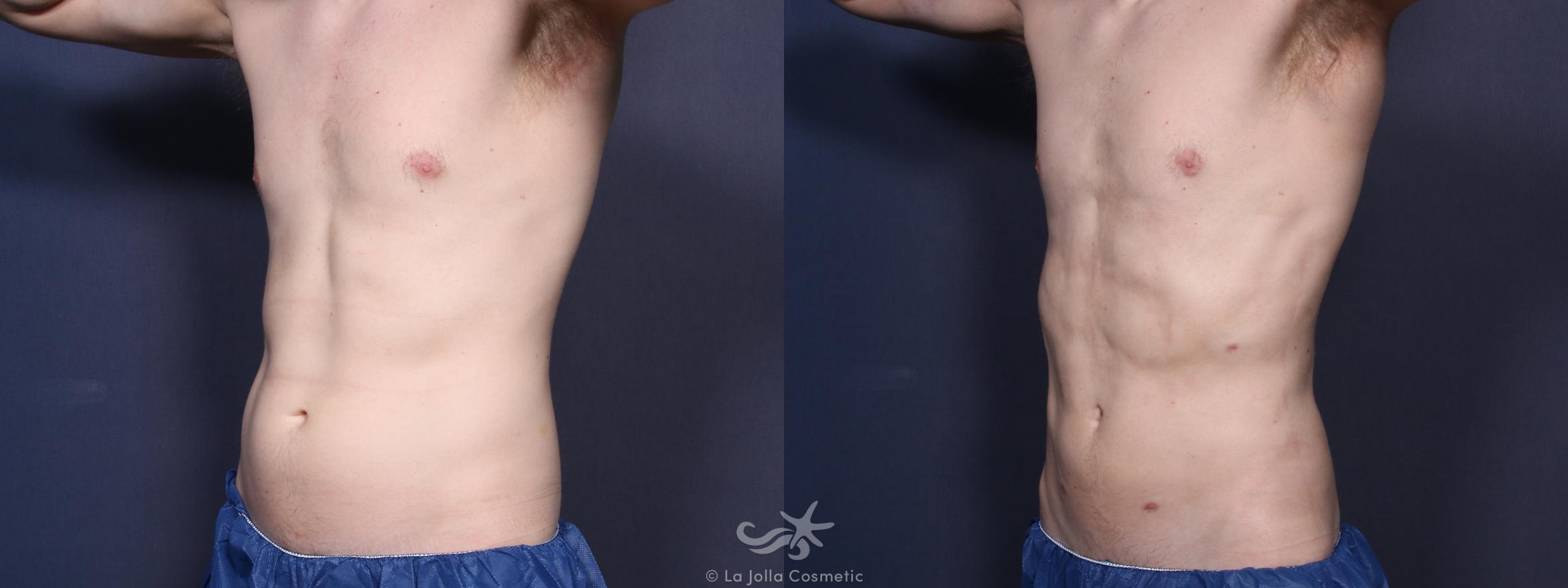 Before & After High Definition Liposuction Result 90 Left Oblique View in San Diego, CA