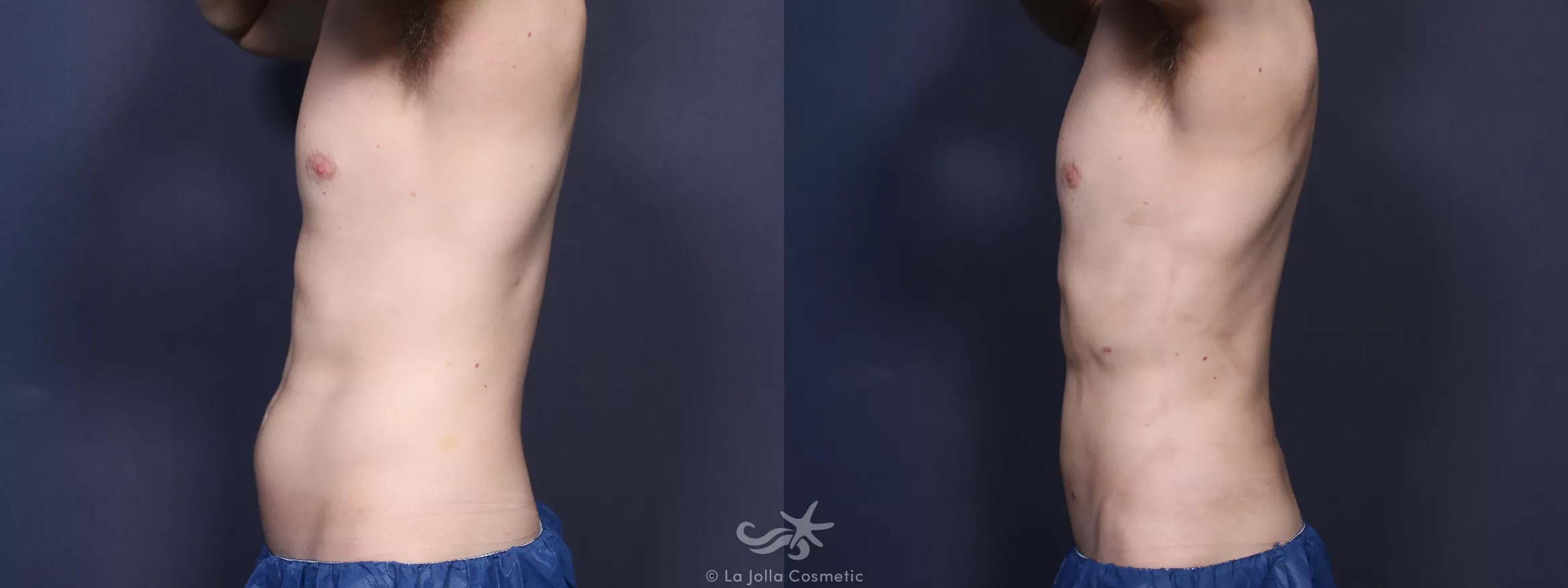 Before & After High Definition Liposuction Result 90 Left Side View in San Diego, CA