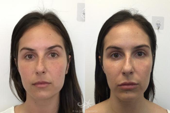 Before & After Juvéderm® Result 600 Front View in San Diego, Carlsbad, CA