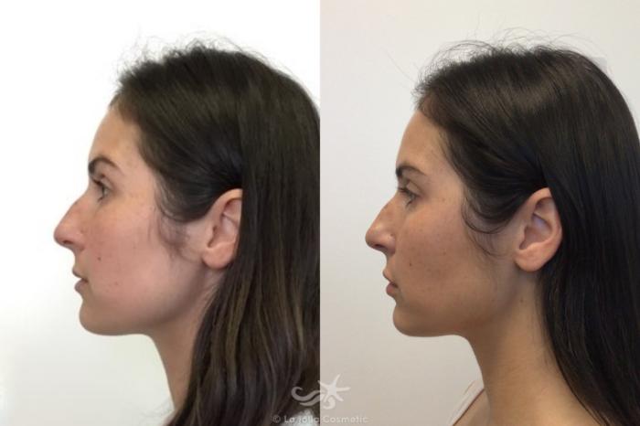 Before & After Juvéderm® Result 600 Left Side View in San Diego, Carlsbad, CA