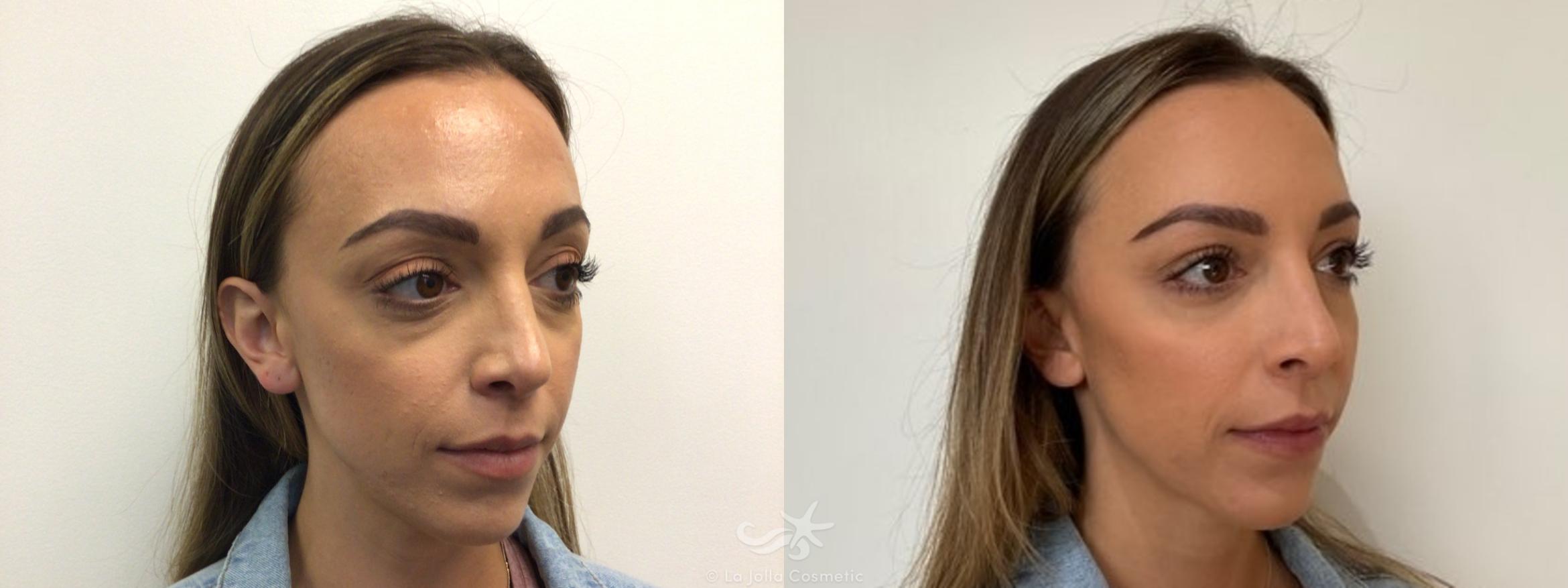 Before & After JUVÉDERM® Result 651 Right Oblique View in San Diego, CA