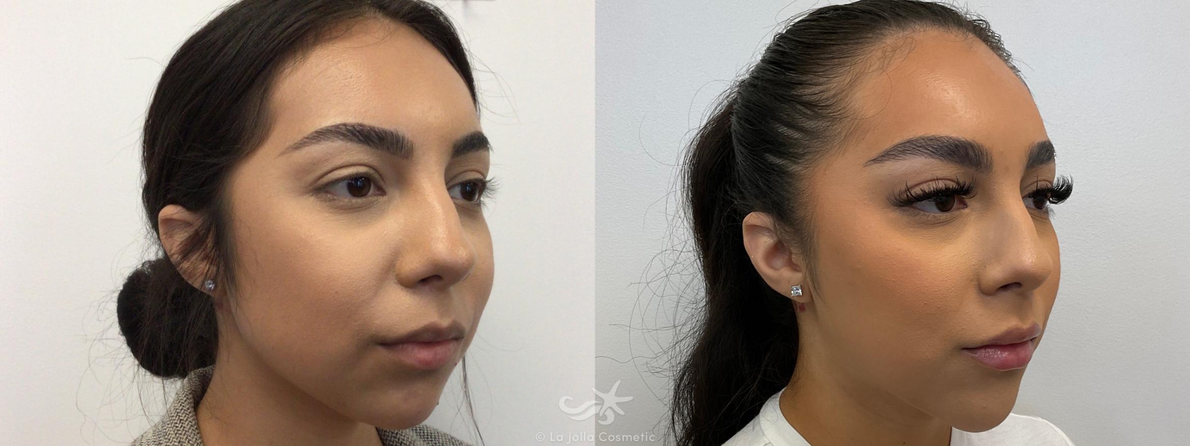 Before & After Juvéderm® Result 710 Right Oblique View in San Diego, CA