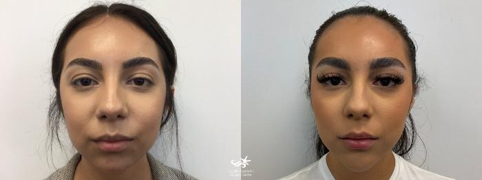 Juvéderm® In San Diego & Carlsbad, Ca | La Jolla Cosmetic Surgery ...