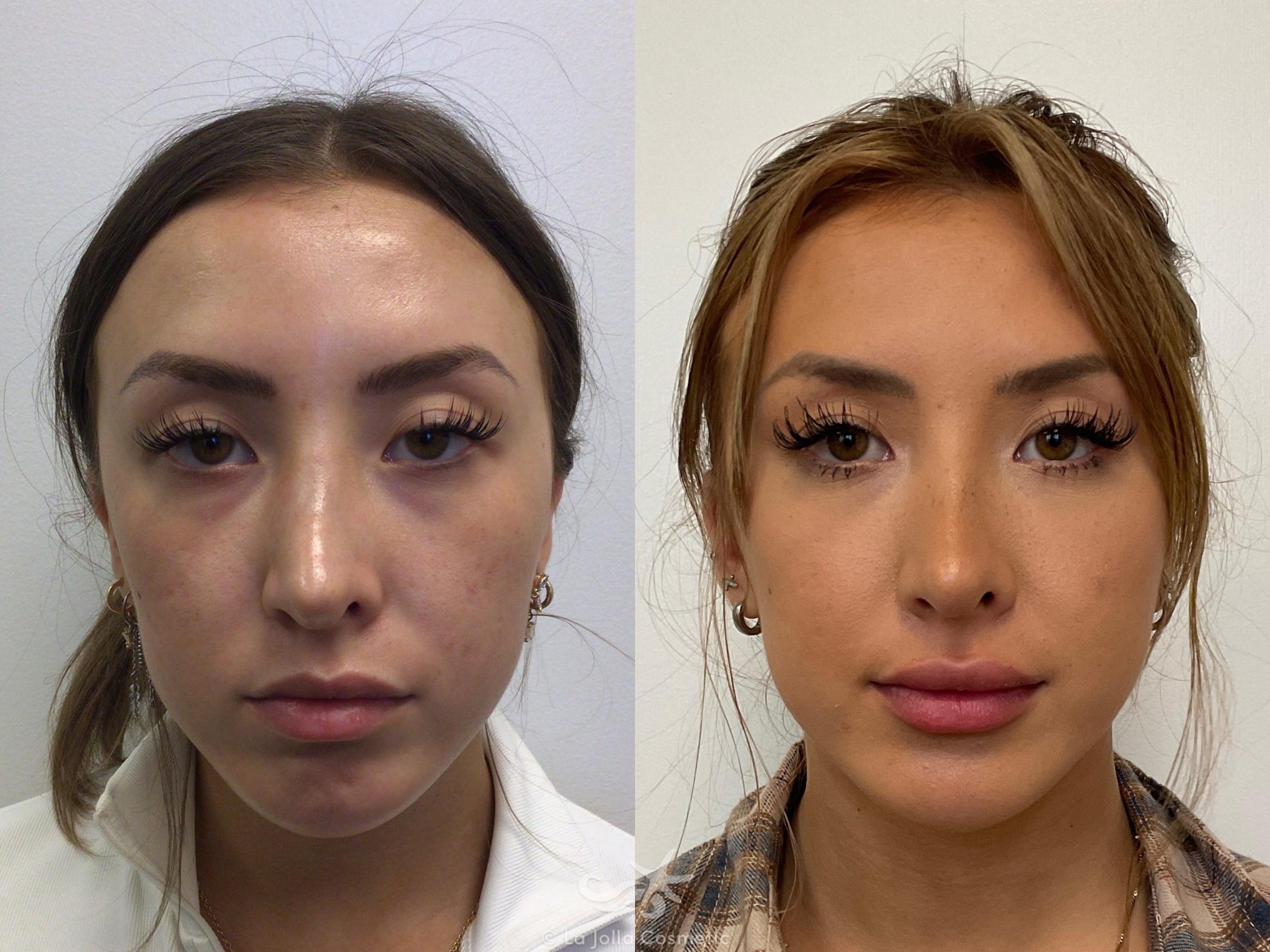 Before & After Juvéderm® Result 721 Front View in San Diego, CA
