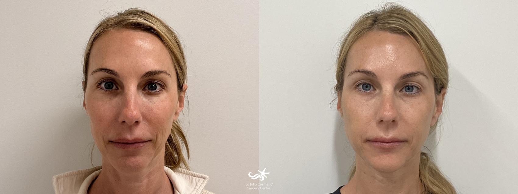 Juvéderm® In San Diego & Carlsbad, Ca | La Jolla Cosmetic Surgery ...