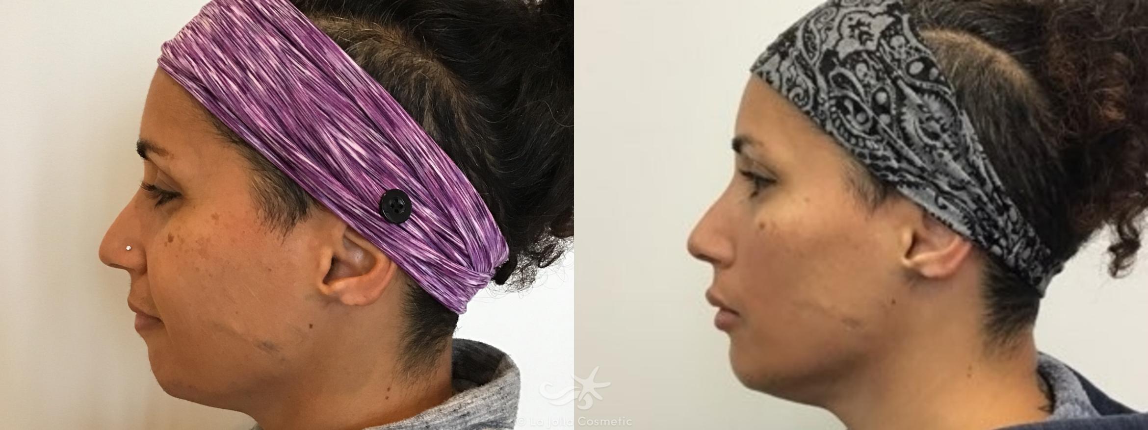 Before & After JUVÉDERM® VOLBELLA™ Result 599 Left Side View in San Diego, CA