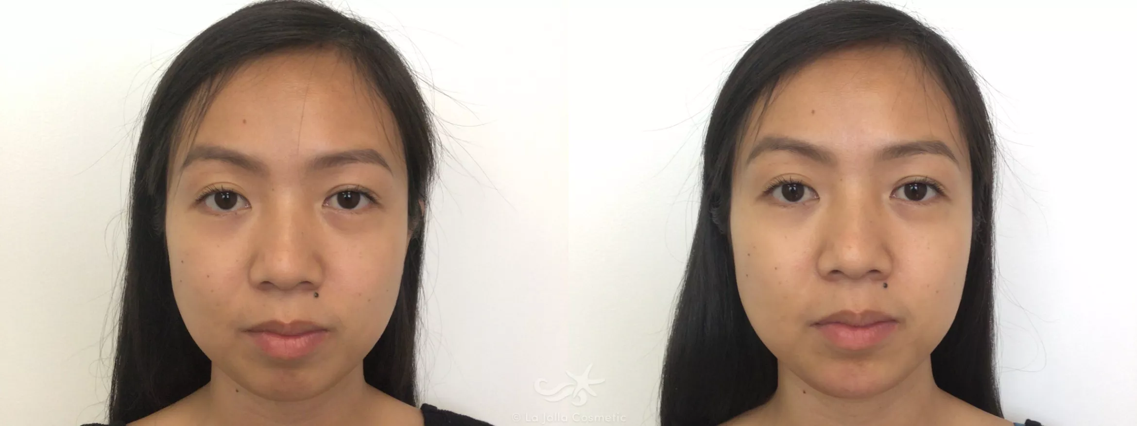 Before & After Juvéderm® Voluma™ Result 128 Front View in San Diego, CA