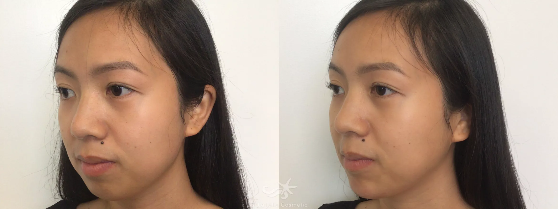 Before & After Juvéderm® Voluma™ Result 128 Left Oblique View in San Diego, CA