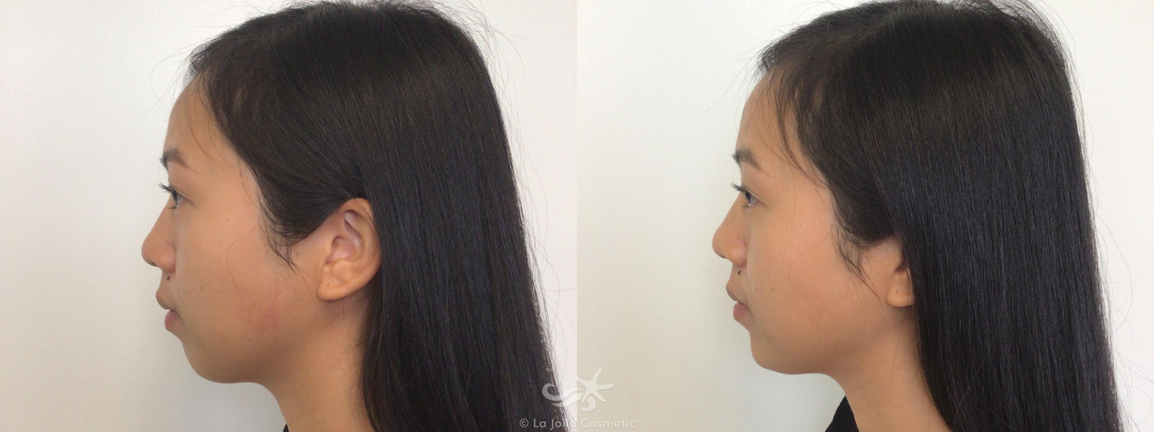 Before & After JUVÉDERM® VOLUMA™ Result 128 Left Side View in San Diego, CA