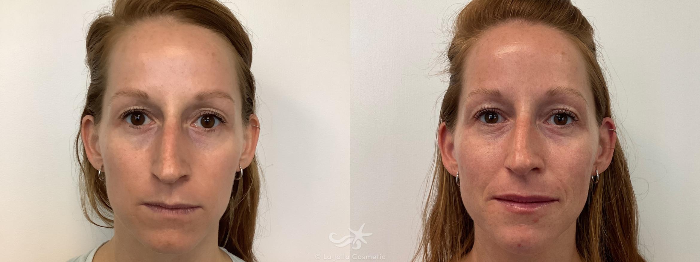 Before & After Juvéderm® Voluma™ Result 652 Front View in San Diego, CA