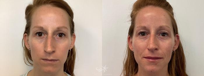 Before & After Juvéderm® Voluma™ Result 652 Front View in San Diego, Carlsbad, CA