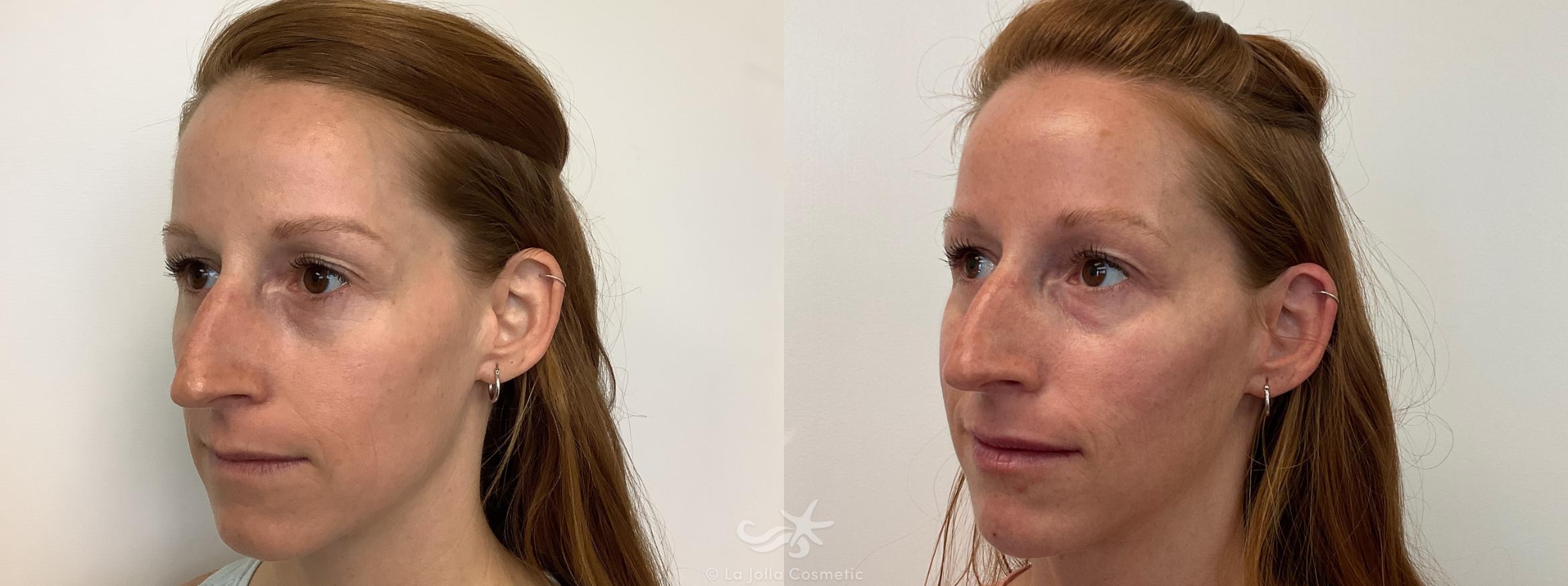 Before & After JUVÉDERM® VOLUMA™ Result 652 Left Oblique View in San Diego, CA