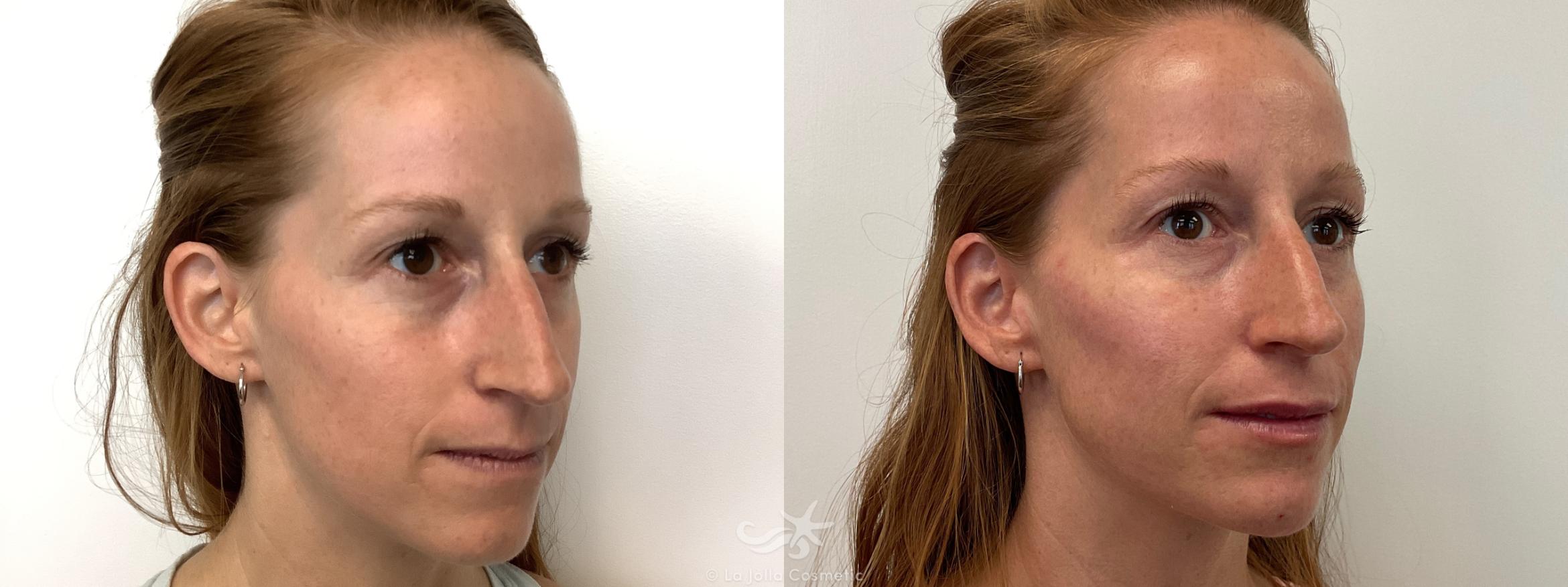 Before & After JUVÉDERM® VOLUMA™ Result 652 Right Oblique View in San Diego, CA