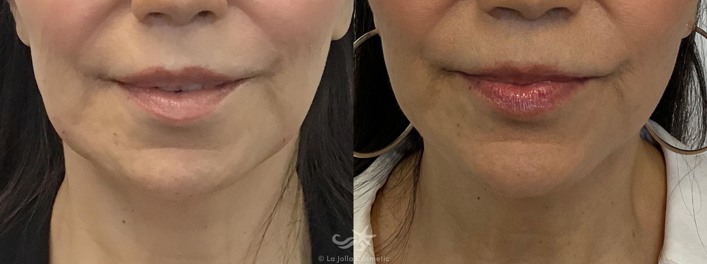 Before & After JUVÉDERM® VOLUMA™ Result 653 Front View in San Diego, CA