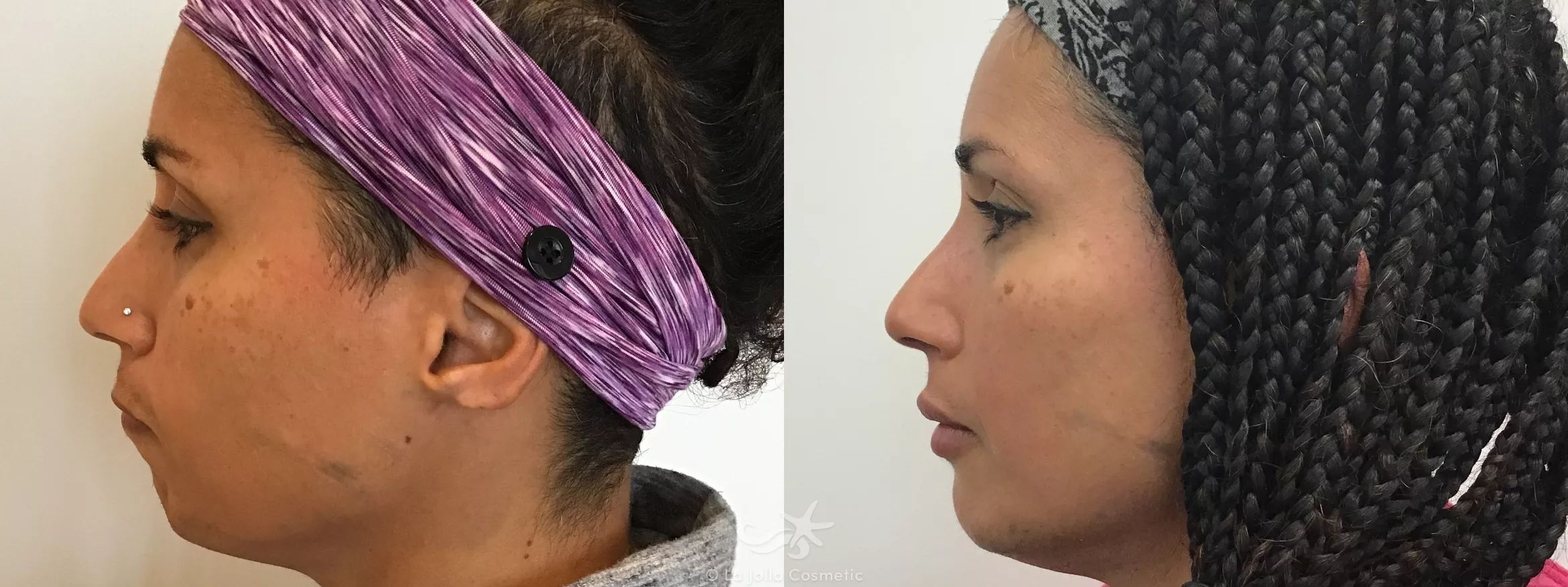 Before & After Juvéderm® Voluma™ Result 655 Left Side View in San Diego, CA