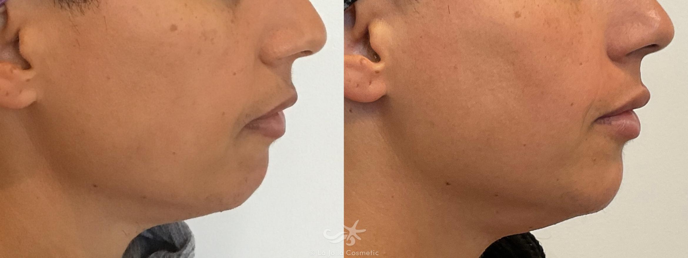 Before & After JUVÉDERM® VOLUMA™ Result 655 Right Side View in San Diego, CA