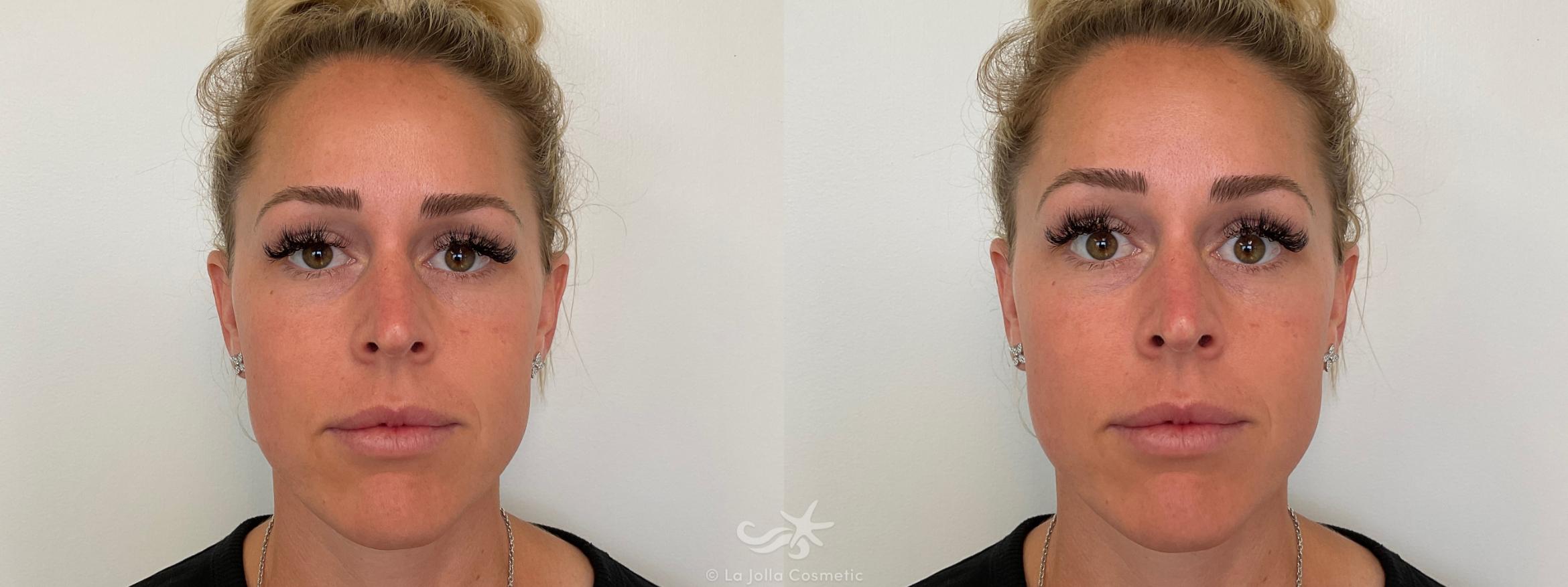 Before & After Juvéderm® Voluma™ Result 690 Front View in San Diego, CA