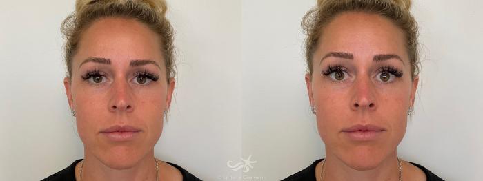 Before & After Juvéderm® Voluma™ Result 690 Front View in San Diego, Carlsbad, CA
