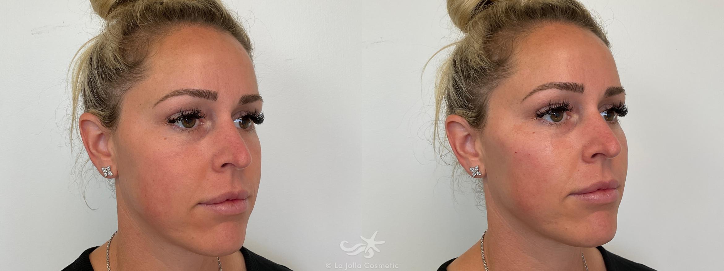 Before & After Juvéderm® Voluma™ Result 690 Left Oblique View in San Diego, CA