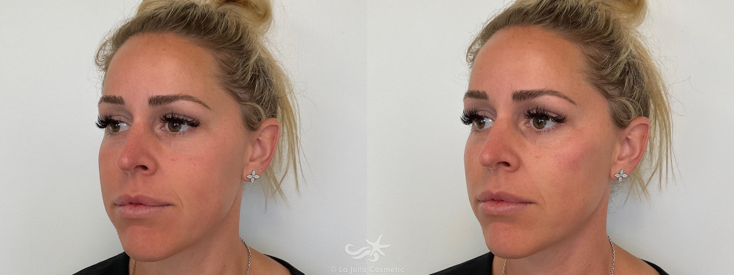 Before & After Juvéderm® Voluma™ Result 690 Right Oblique View in San Diego, CA