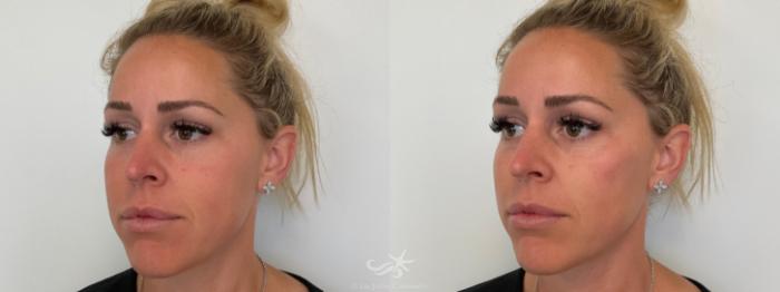 Before & After Juvéderm® Voluma™ Result 690 Right Oblique View in San Diego, Carlsbad, CA