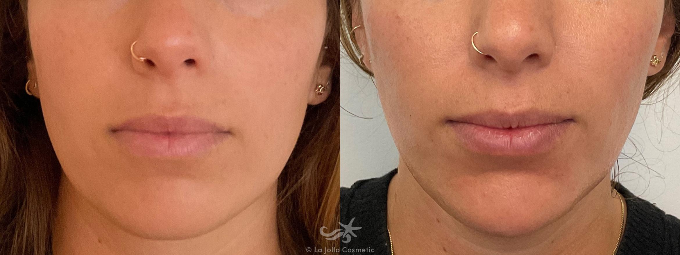 Before & After Juvéderm® Voluma™ Result 694 Front View in San Diego, CA