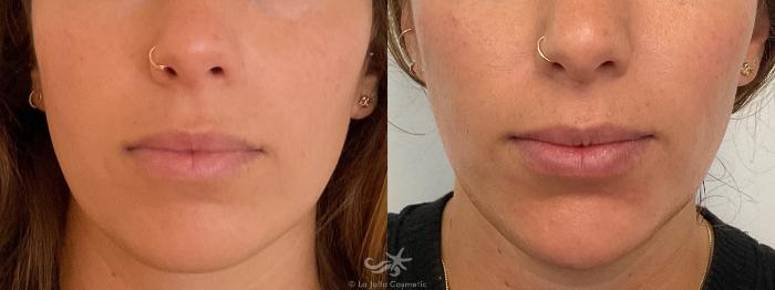 Before & After Juvéderm® Voluma™ Result 694 Front View in San Diego, Carlsbad, CA