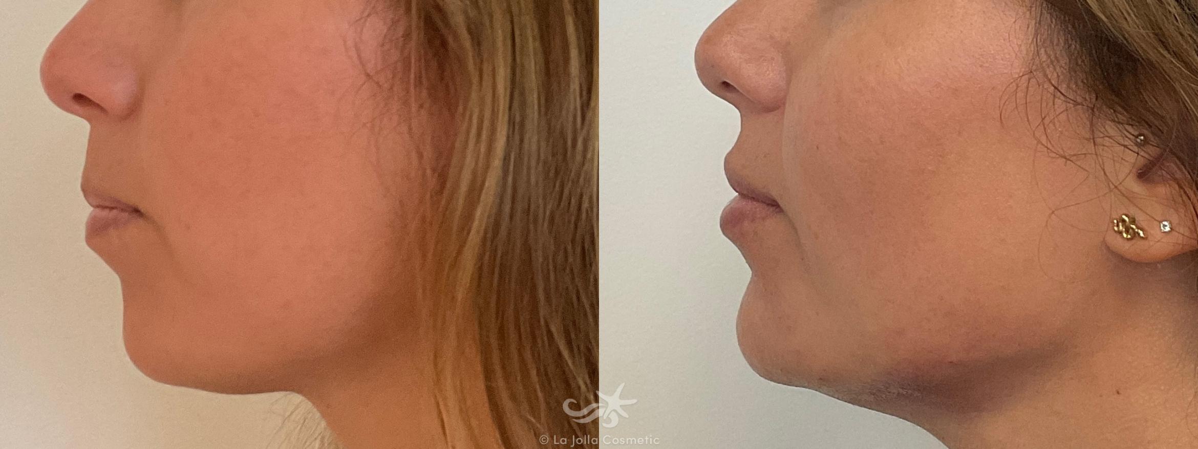 Before & After Juvéderm® Voluma™ Result 694 Left Side View in San Diego, CA